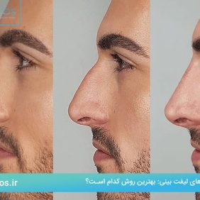 روش‌های لیفت بینی: بهترین روش کدام است؟