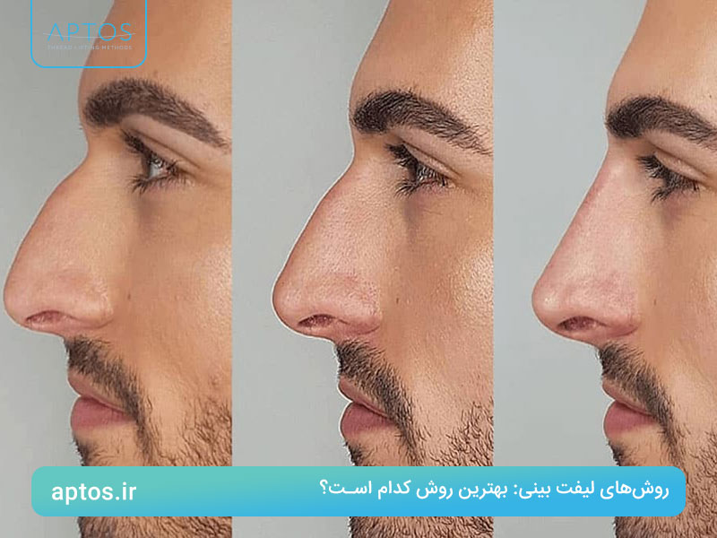 روش‌های لیفت بینی: بهترین روش کدام است؟