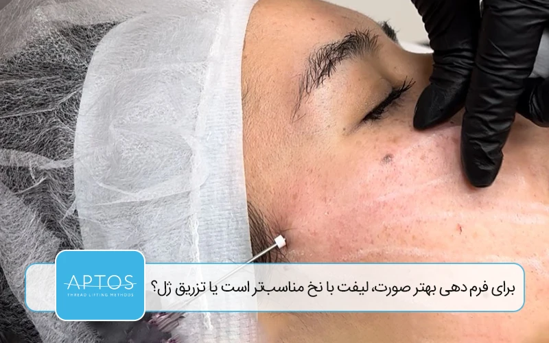 برای فرم‌ دهی بهتر صورت، لیفت با نخ مناسب‌تر است یا تزریق ژل؟