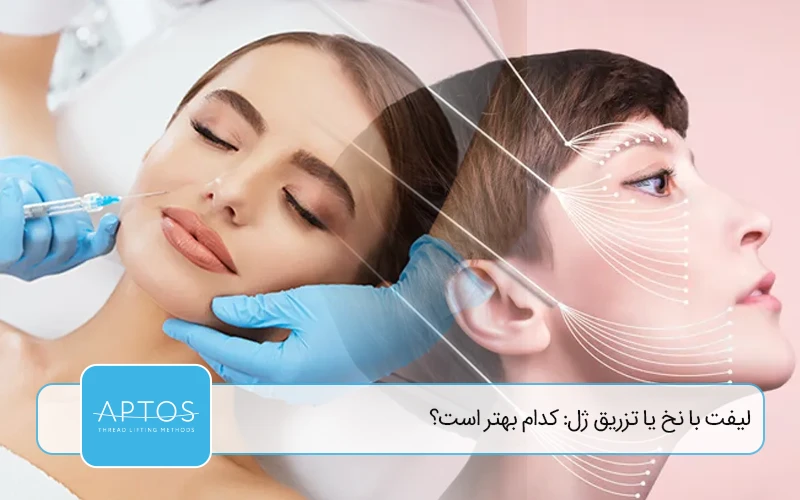 لیفت با نخ یا تزریق ژل: کدام بهتر است؟