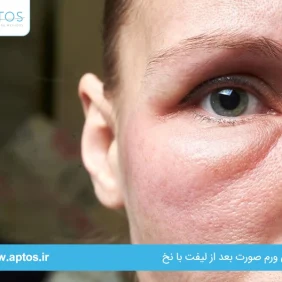 درمان ورم صورت بعد از لیفت با نخ | راهنمای جامع تخصصی