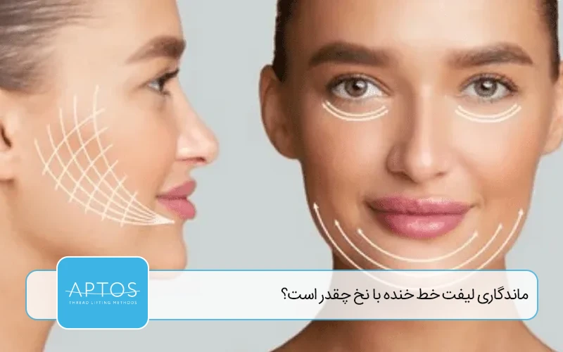 ماندگاری لیفت خط خنده با نخ چقدر است؟