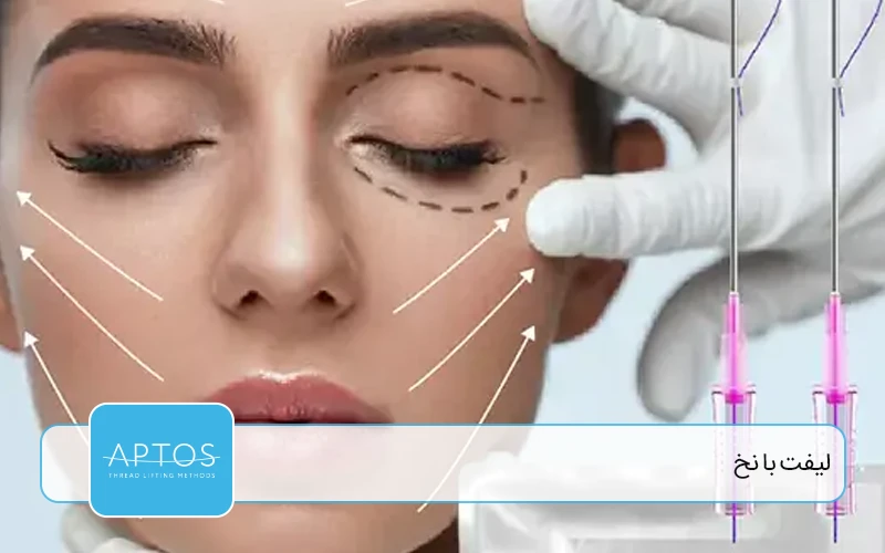 لیفت با نخ (Thread Lift)