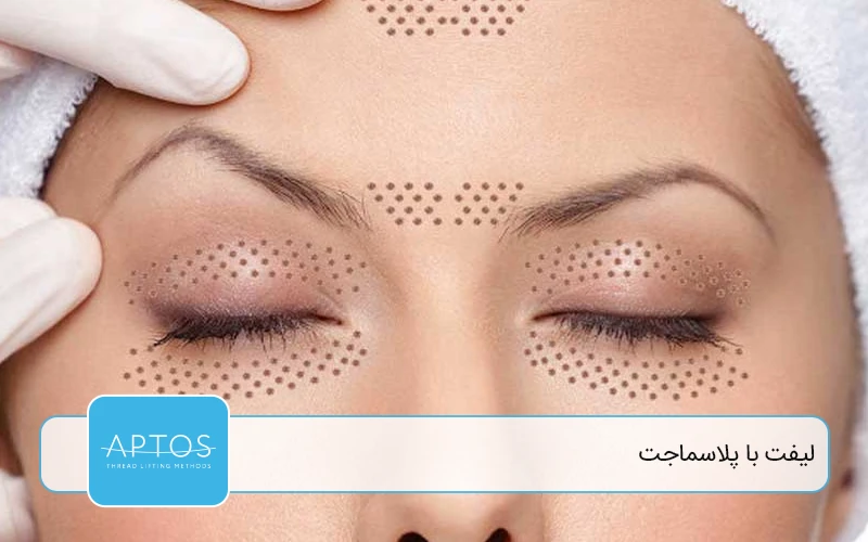 لیفت با پلاسماجت (Plasma Lift)