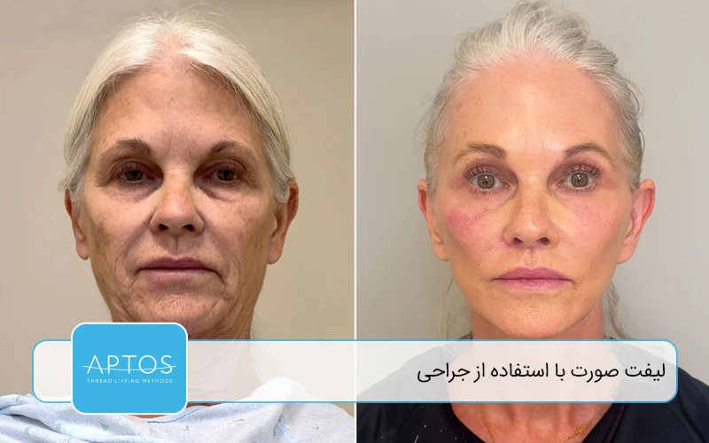 لیفت صورت با استفاده از جراحی (Surgical Facelift)