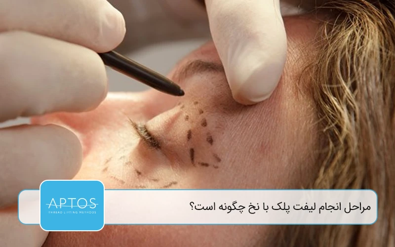 مراحل انجام لیفت پلک با نخ چگونه است؟