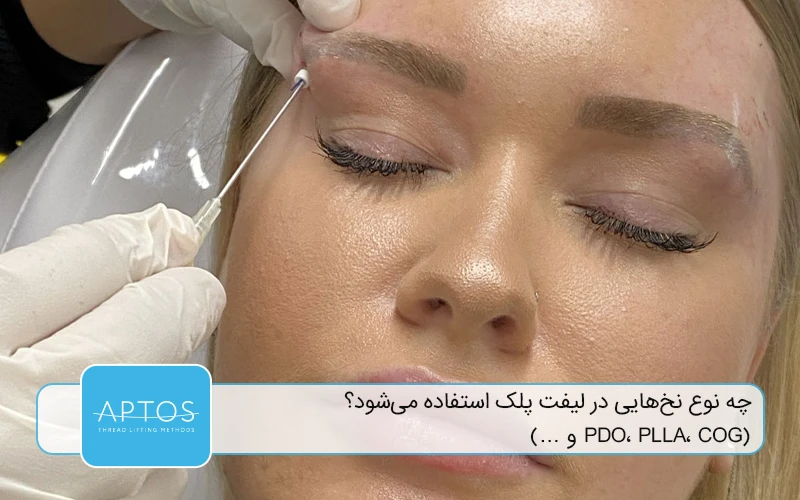 چه نوع نخ‌هایی در لیفت پلک استفاده می‌شود؟