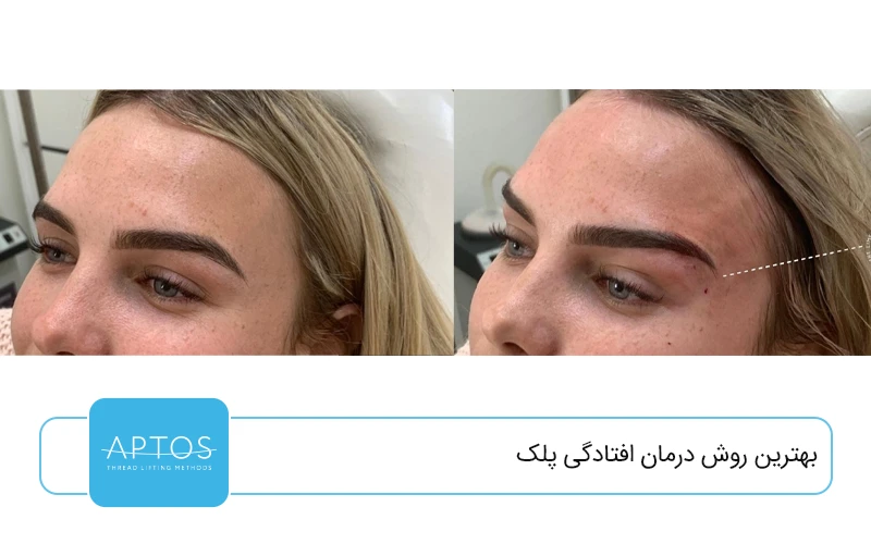 بهترین روش درمان افتادگی پلک