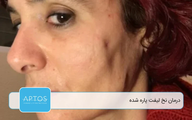  راه‌های پیشگیری از پاره شدن نخ لیفت