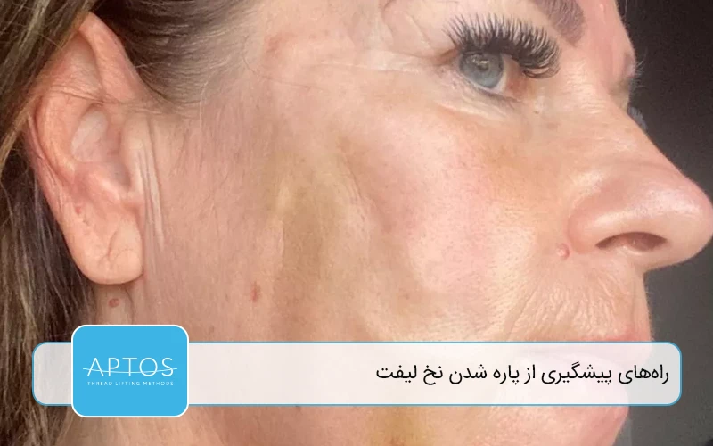  راه‌ های پیشگیری از پاره شدن نخ لیفت