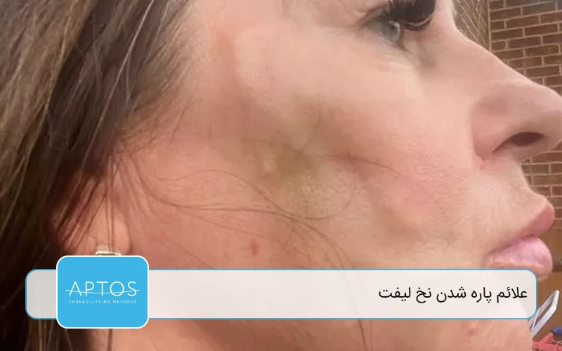  علل رایج پاره شدن نخ لیفت