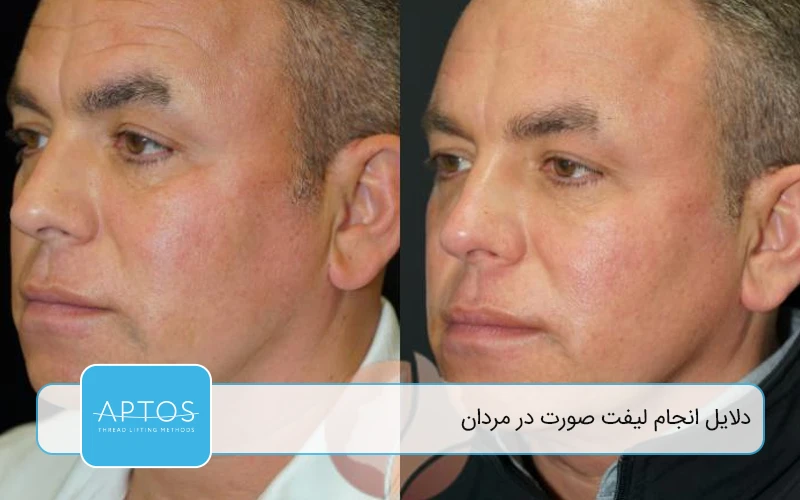 دلایل انجام لیفت صورت در مردان