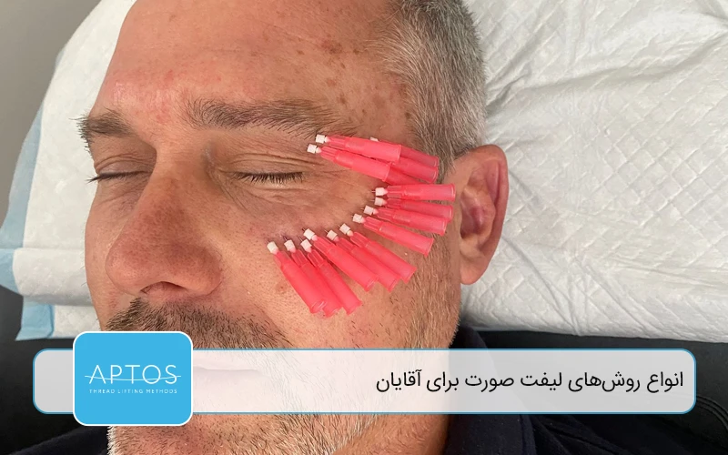 انواع روش‌های لیفت صورت برای آقایان