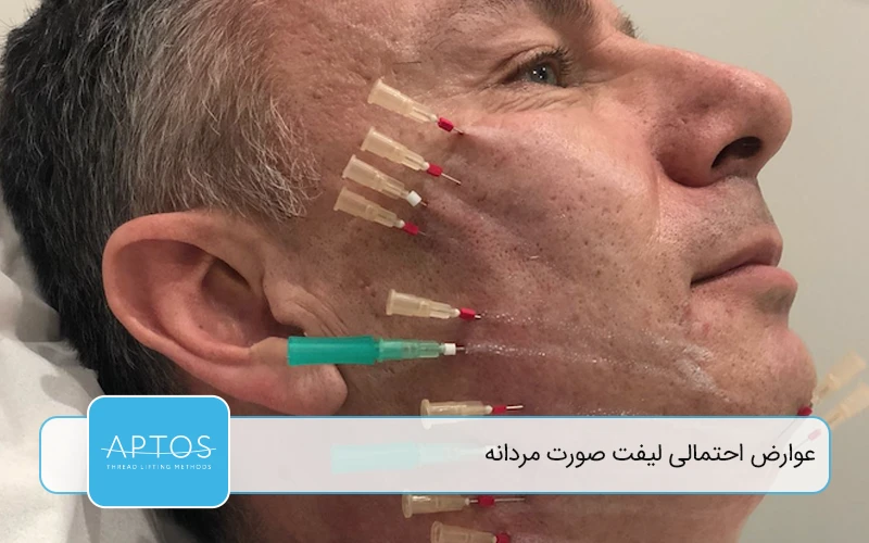 عوارض احتمالی لیفت صورت مردانه