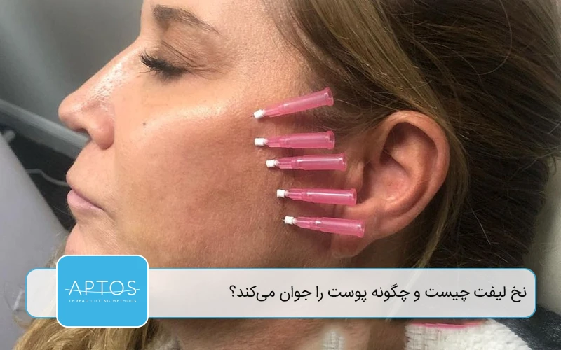  نخ لیفت چیست و چگونه پوست را جوان می‌کند؟