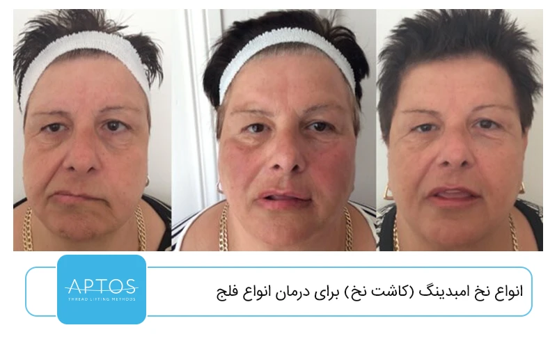 انواع نخ امبدینگ (کاشت نخ) برای درمان انواع فلج