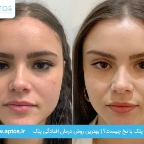 لیفت پلک با نخ چیست؟