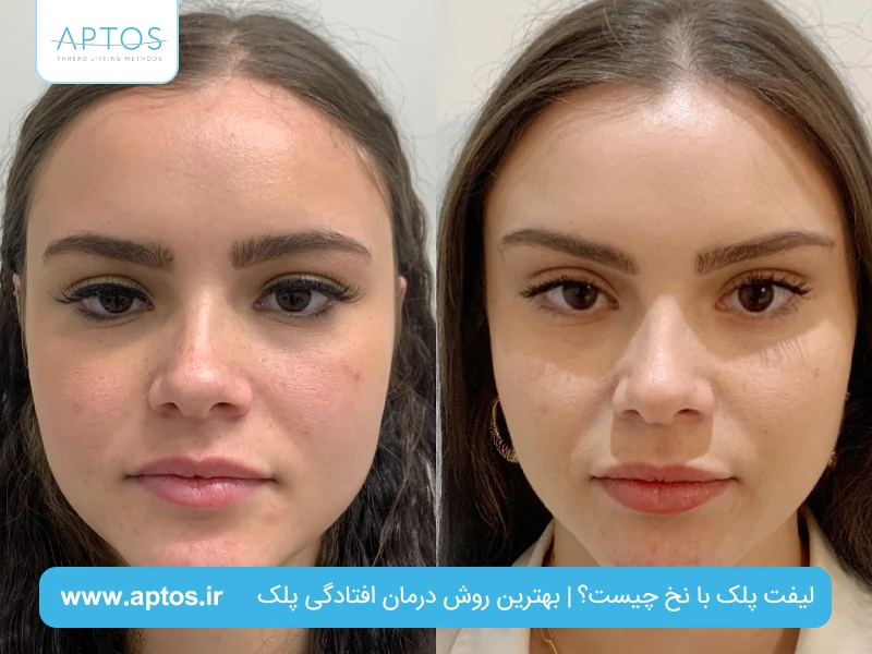 لیفت پلک با نخ چیست؟