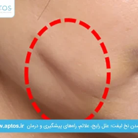 پاره شدن نخ لیفت: علل رایج، علائم، راه‌های پیشگیری و درمان