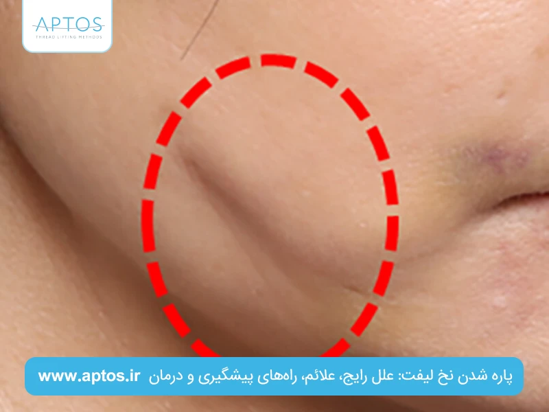 پاره شدن نخ لیفت: علل رایج، علائم، راه‌های پیشگیری و درمان