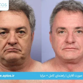 لیفت صورت آقایان | راهنمای کامل + مزایا