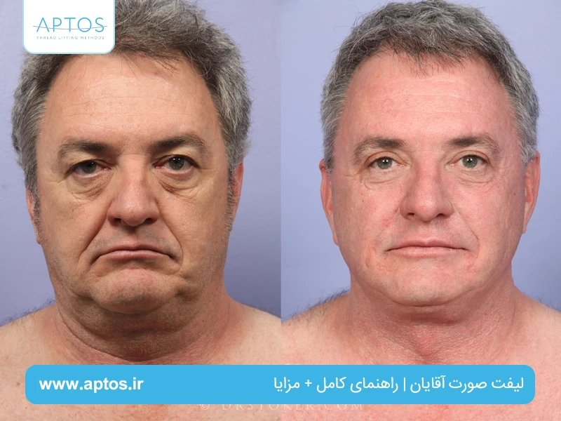 لیفت صورت آقایان | راهنمای کامل + مزایا