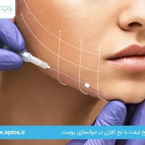 فرق نخ لیفت با نخ کلاژن در جوانسازی پوست