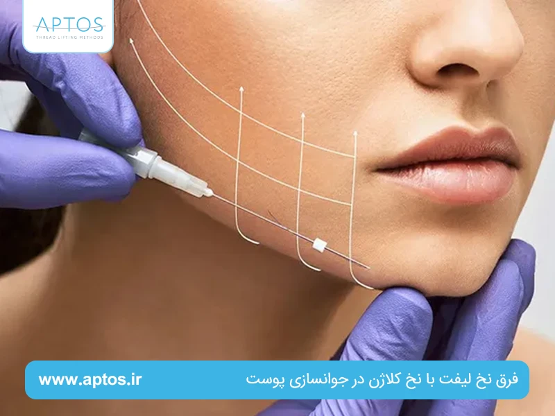 فرق نخ لیفت با نخ کلاژن در جوانسازی پوست