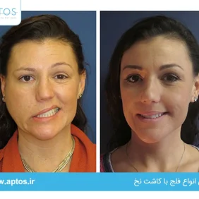 درمان انواع فلج با کاشت نخ