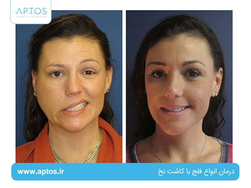 درمان انواع فلج با کاشت نخ